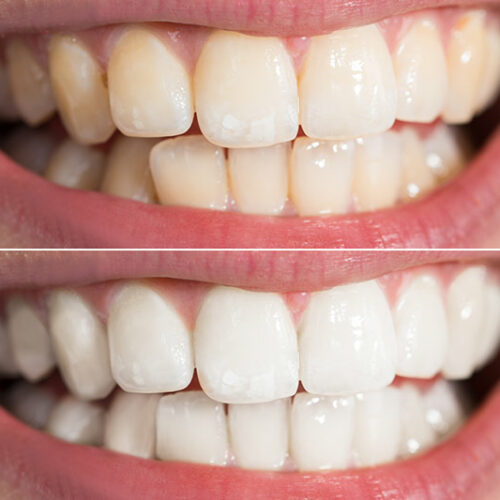 Zoom Teeth Whitening at Fitzgerald Dentistry