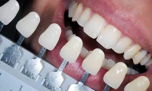 tooth-colored-filling-photo